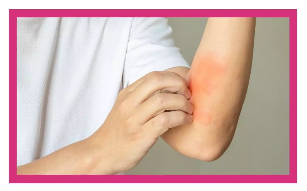 Eczema