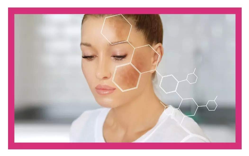 Hyperpigmentation